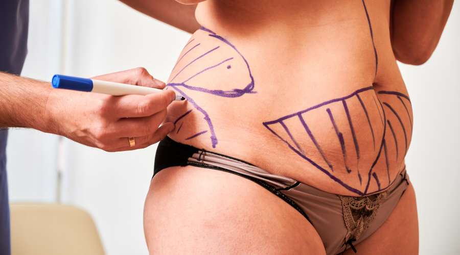 La liposuccion démystifiée pour mieux comprendre cette chirurgie esthétique